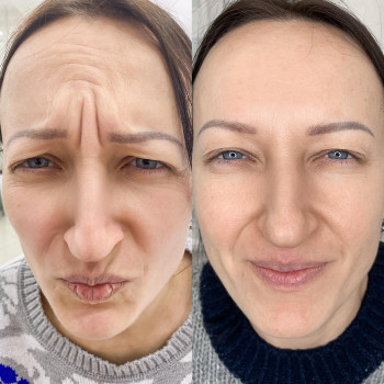 Ботокс
                    Косметолог-ін'єкціоніст Елена Київ