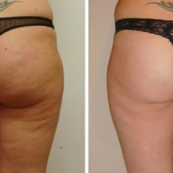 Медовый массаж + обёртывание курсом.