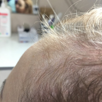 после 4 процедур растут новенькие волосики