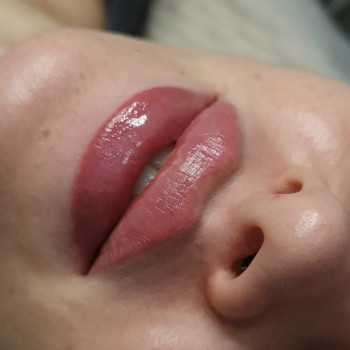 Контурная пластика лица
                    Косметолог-инъекционист Алина Днепр