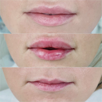 Контурная пластика лица
                    Косметолог-инъекционист Алина Днепр