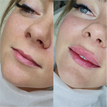 Контурная пластика лица
                    Косметолог-инъекционист Алина Днепр