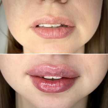 Контурная пластика лица
                    Косметолог-инъекционист Алина Днепр