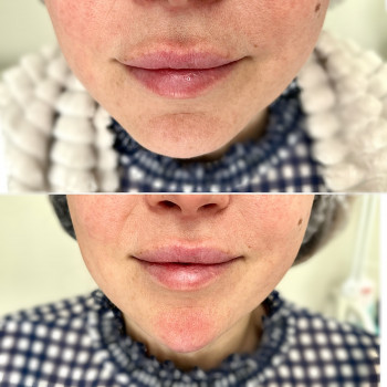 Контурная пластика лица
                    Косметолог-инъекционист Алина Днепр