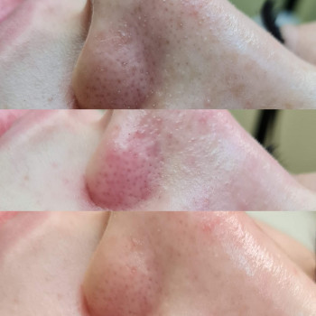 Чистка лица
                    Косметолог Анастасия Одеса