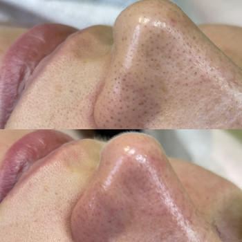 Чистка лица
                    Косметолог Анастасия Одеса