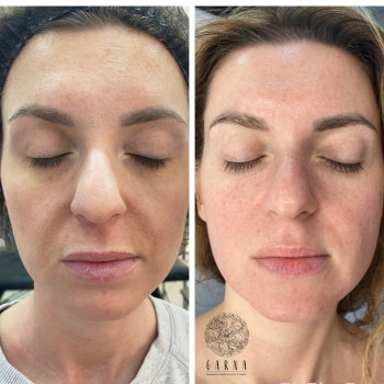 SMAS Массаж лица
                    СПА-салон GARNA Мариуполь