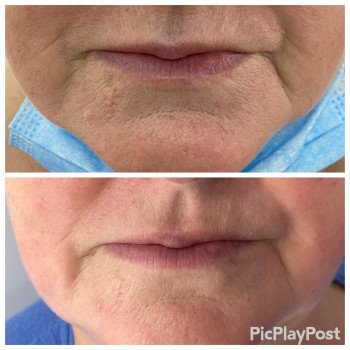 SMAS Массаж лица
                    СПА-салон GARNA Мариуполь