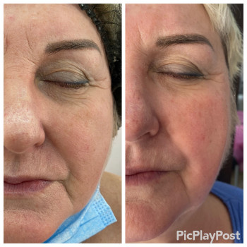 SMAS Массаж лица
                    СПА-салон GARNA Мариуполь