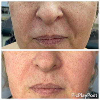 SMAS Массаж лица
                    СПА-салон GARNA Мариуполь