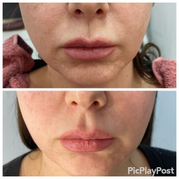 RF-lifting лица
                    СПА-салон GARNA Маріуполь