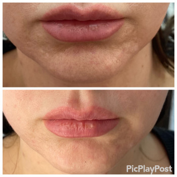 RF-lifting лица
                    СПА-салон GARNA Маріуполь