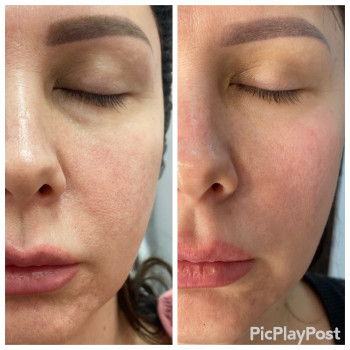 RF-lifting лица
                    СПА-салон GARNA Маріуполь