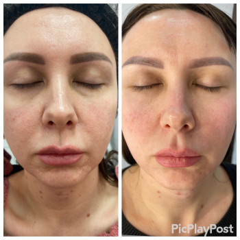 RF-lifting лица
                    СПА-салон GARNA Маріуполь