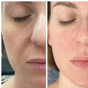 RF-lifting + SMAS massage лица
                    СПА-салон GARNA Маріуполь