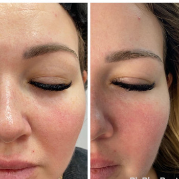 RF-lifting + SMAS massage лица
                    СПА-салон GARNA Маріуполь