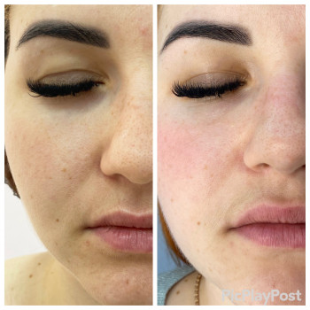 RF-lifting + SMAS massage лица
                    СПА-салон GARNA Маріуполь