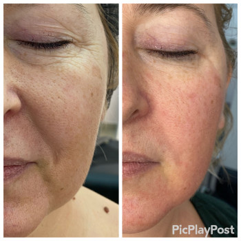 RF-lifting + SMAS massage лица
                    СПА-салон GARNA Маріуполь