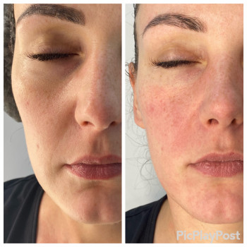 RF-lifting + SMAS massage лица
                    СПА-салон GARNA Маріуполь