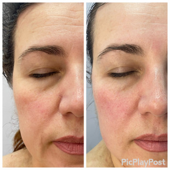 RF-lifting + SMAS massage лица
                    СПА-салон GARNA Маріуполь