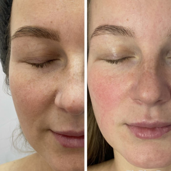 RF-lifting + SMAS massage лица
                    СПА-салон GARNA Маріуполь