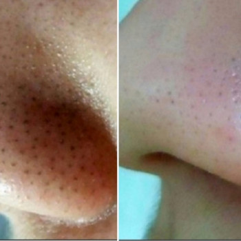 Комбинированная чистка лица