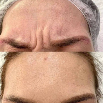 Ботокс До/После