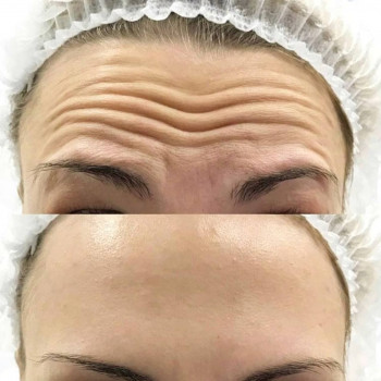 Ботокс До/После