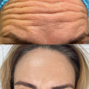 Ботокс До/После