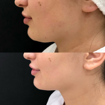 Липолифтинг MESOSCULPT™ C71
                    Косметолог Анастасия Одесса