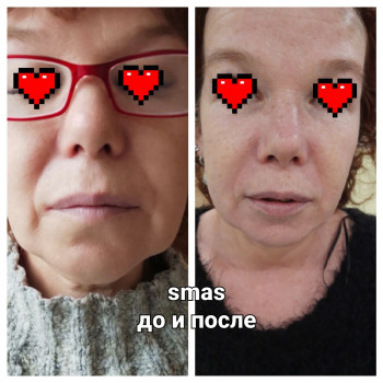  
 
Коррекция носогубных складок и брылей.
52 года