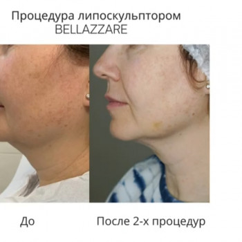 Устранение 2го подбородка