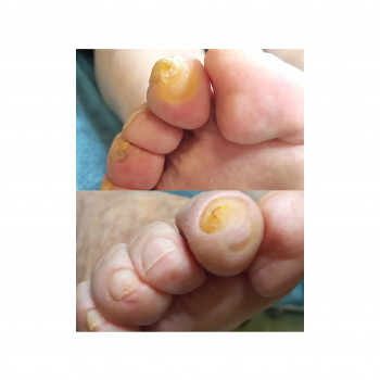 Удаление мозоли