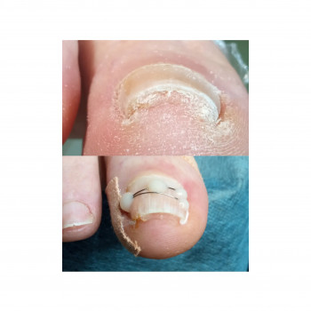 Решение вопроса деформации ногтевой пластины с помощью корре