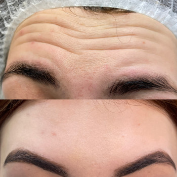 Ботокс/ ботулинотерапия
                    Косметолог Анастасия Одесса