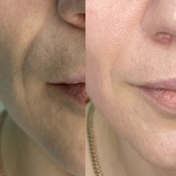 Липолифтинг MESOSCULPT™ C71
                    Косметолог Анастасия Одесса