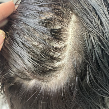 Детокс/Пілінг шкіри голови
                    Салон краси Vakaruk Keratin Studio Київ