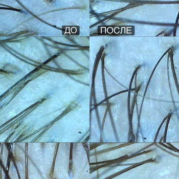 Результат эксфолиации ( пилинг ) кожи головы