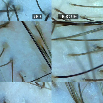 Результат эксфолиации ( пилинг ) кожи головы