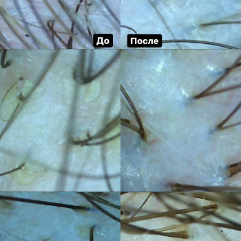 Результат эксфолиации ( пилинг ) кожи головы