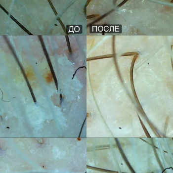 Результат эксфолиации ( пилинг ) кожи головы