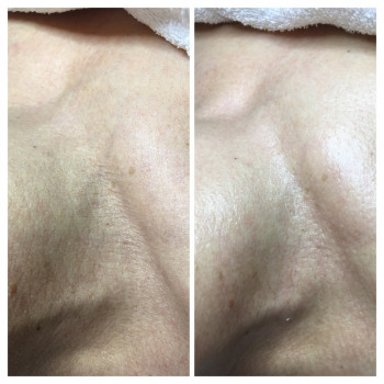 Результат после 1-й процедуры омоложения кожи лица, шеи и де