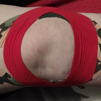 Фиксация гипермобильности