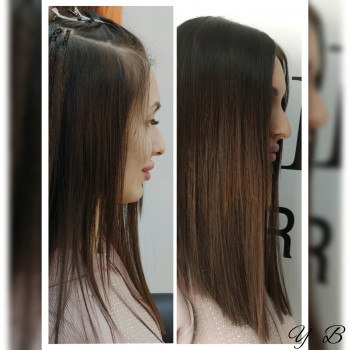 Загущение височной зоны