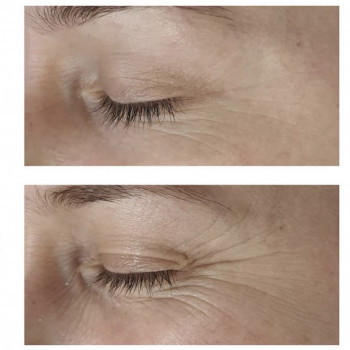 Ботулінотерапія
                    Салон красоты Atmosfera Krasu Черновцы