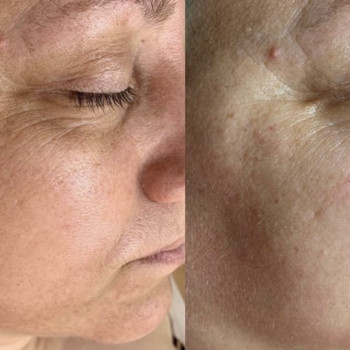 Ботулінотерапія
                    Салон красоты Atmosfera Krasu Черновцы