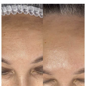 Ботулінотерапія
                    Салон красоты Atmosfera Krasu Черновцы