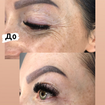 Ботулінотерапія
                    Салон красоты Atmosfera Krasu Черновцы