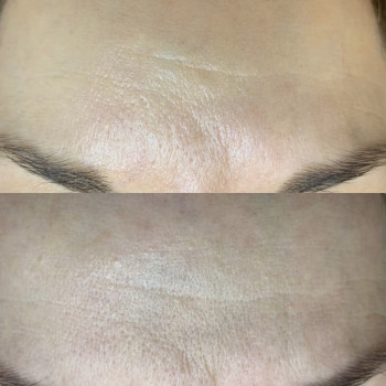 Ботулінотерапія
                    Салон красоты Atmosfera Krasu Черновцы