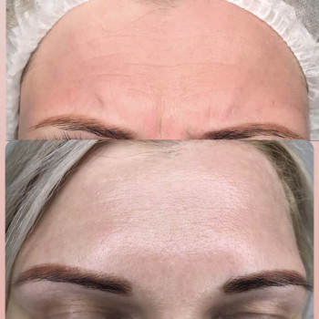 Ботулінотерапія
                    Салон красоты Atmosfera Krasu Черновцы